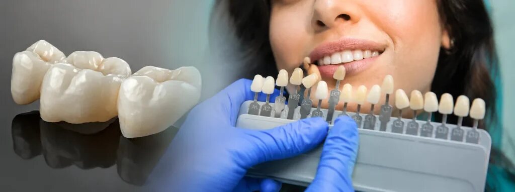 Ceramic dental bridge and shade guide during colour matching in Dover, NJ