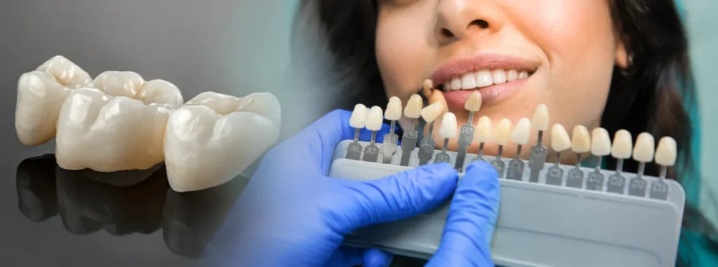 Ceramic dental bridge and shade guide during colour matching in Dover, NJ