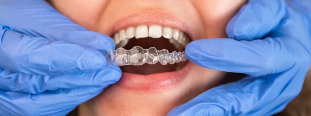 Dentist fitting a clear Invisalign aligner tray for a patient in Dover, NJ